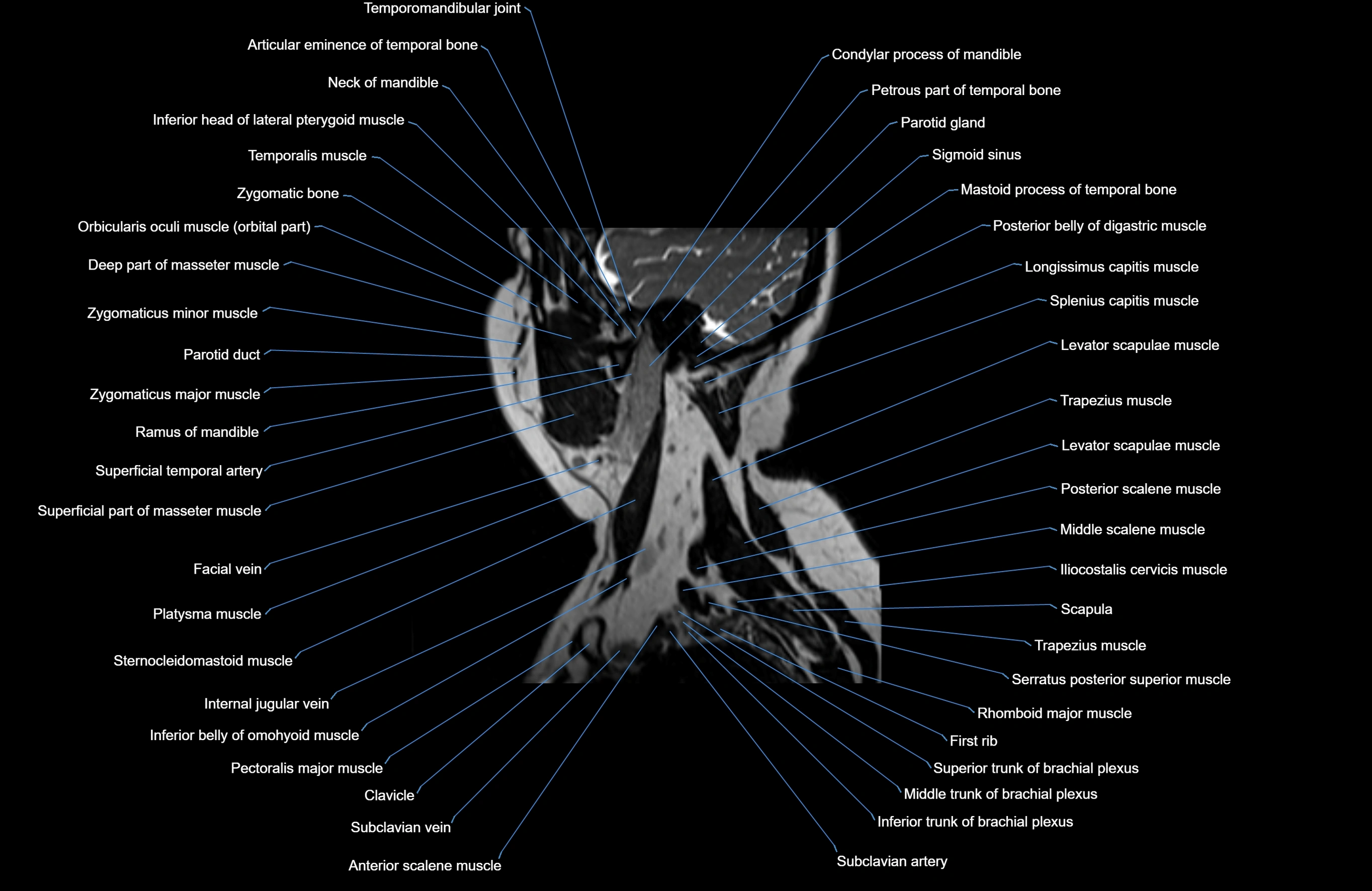 Neck MRI sagittal cross sectional anatomy 3D 1mm 3T radiology  image-img-00001-00030.webp